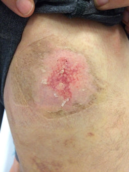 After PowerHeal (9 Days)