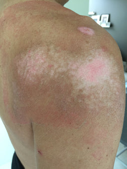 After PowerHeal (7 Days)