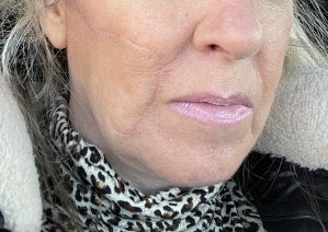 After PowerHeal (3 Months)