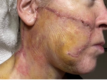 During PowerHeal Treatment