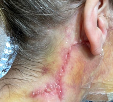 Contrast with Neck Wound