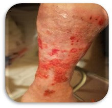 After PowerHeal (2.5 Weeks)