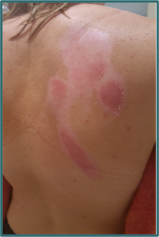 After PowerHeal (19 Days)