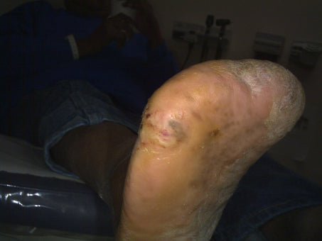 After PowerHeal - Side Foot (15 Days)