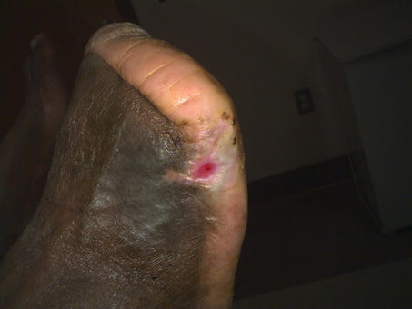 After PowerHeal - Top Foot (15 Days)