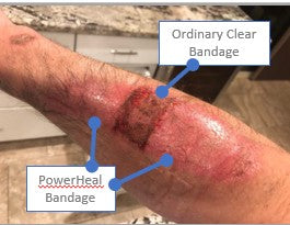 After Bandaging (2 Days)