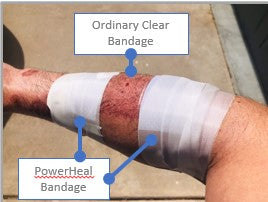 Bandaging