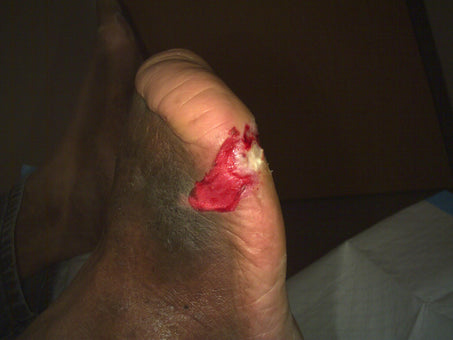 Before PowerHeal - Top Foot