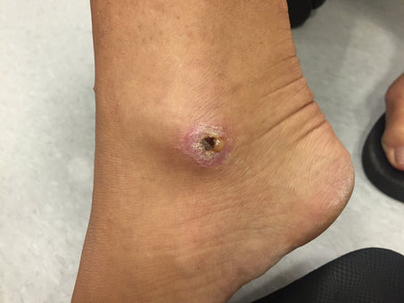 Before PowerHeal - Ankle