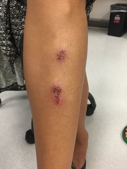 Before PowerHeal - Shin