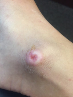 After PowerHeal - Ankle (2 Weeks)