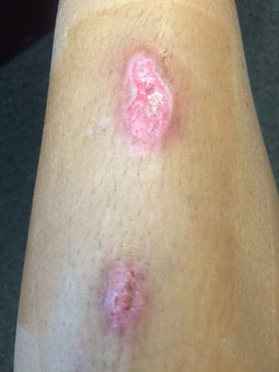 After PowerHeal - Shin (2 Weeks)