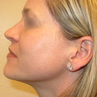 After PowerHeal (4 Days)