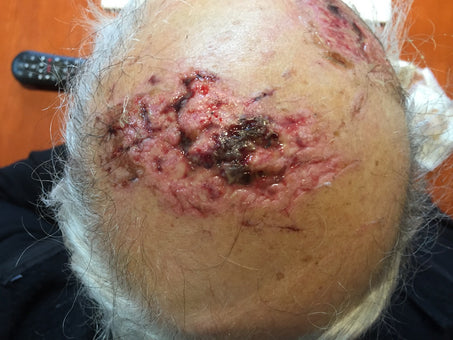 Before PowerHeal (5 Days after Accident)