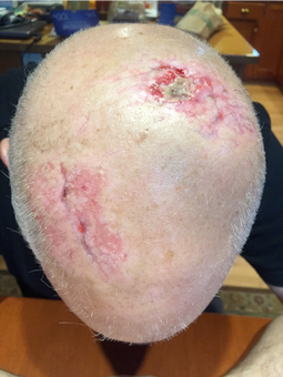 9 Days After PowerHeal (14 Days after Accident):