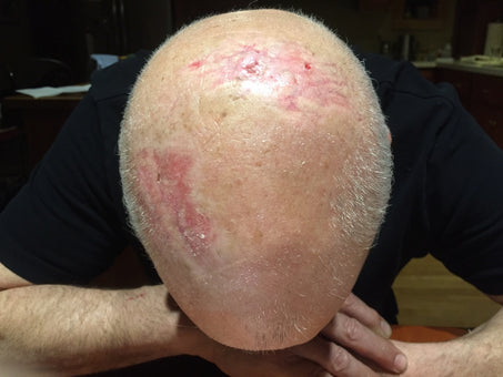 18 Days after PowerHeal (23 Days after Accident)