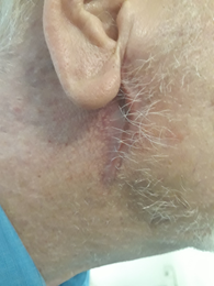 After PowerHeal (4 Months)